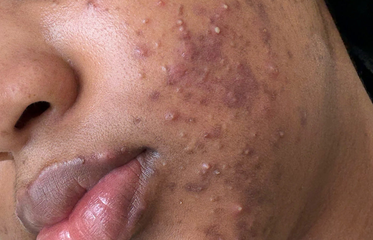 The Acne Mistake Almost EVERYONE Makes - Why Your Acne Isn’t Improving