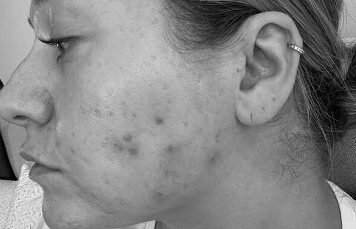 Adult acne image from Dr Sam's community member Grace