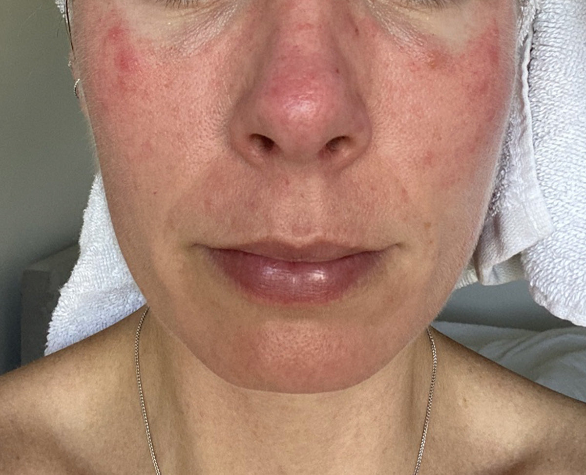 Acne or Rosacea? How to Tell the Difference - and Why It Matters