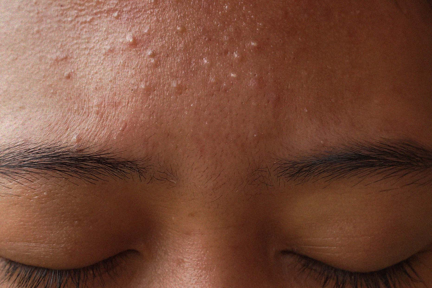 My Favourite Acne Treatments - Tretinoin