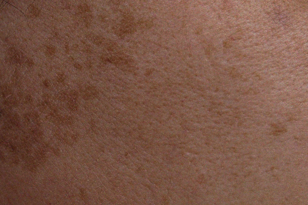 Why Blue Light Matters in Hyperpigmentation