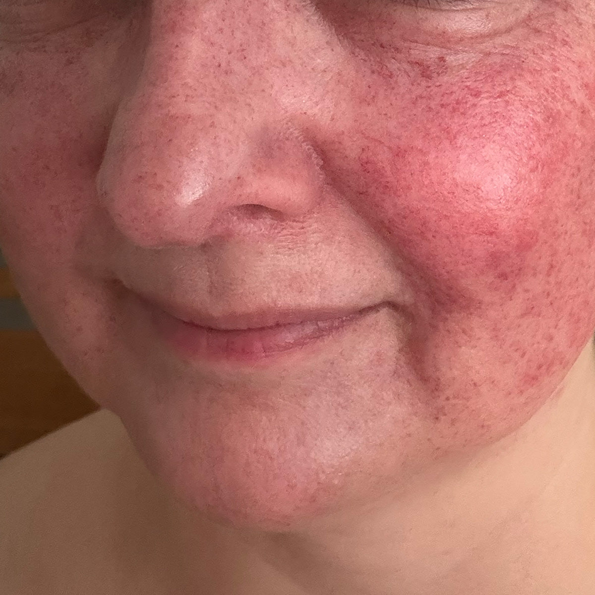 Before image of Redness