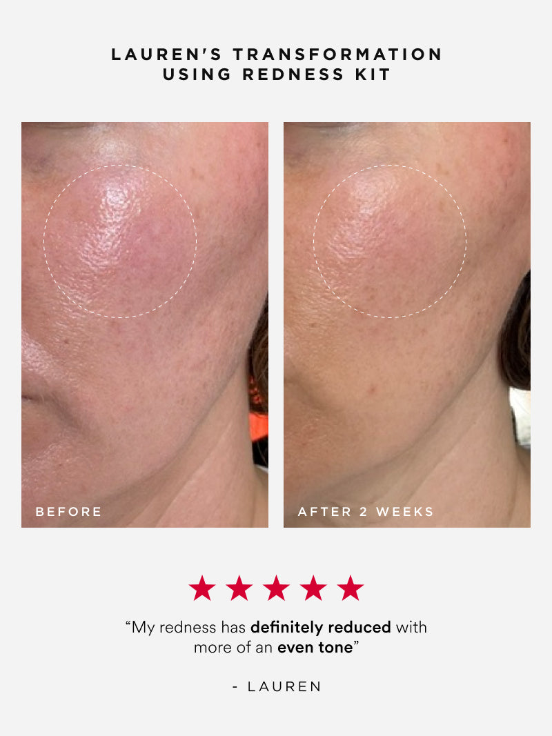 Redness Kit