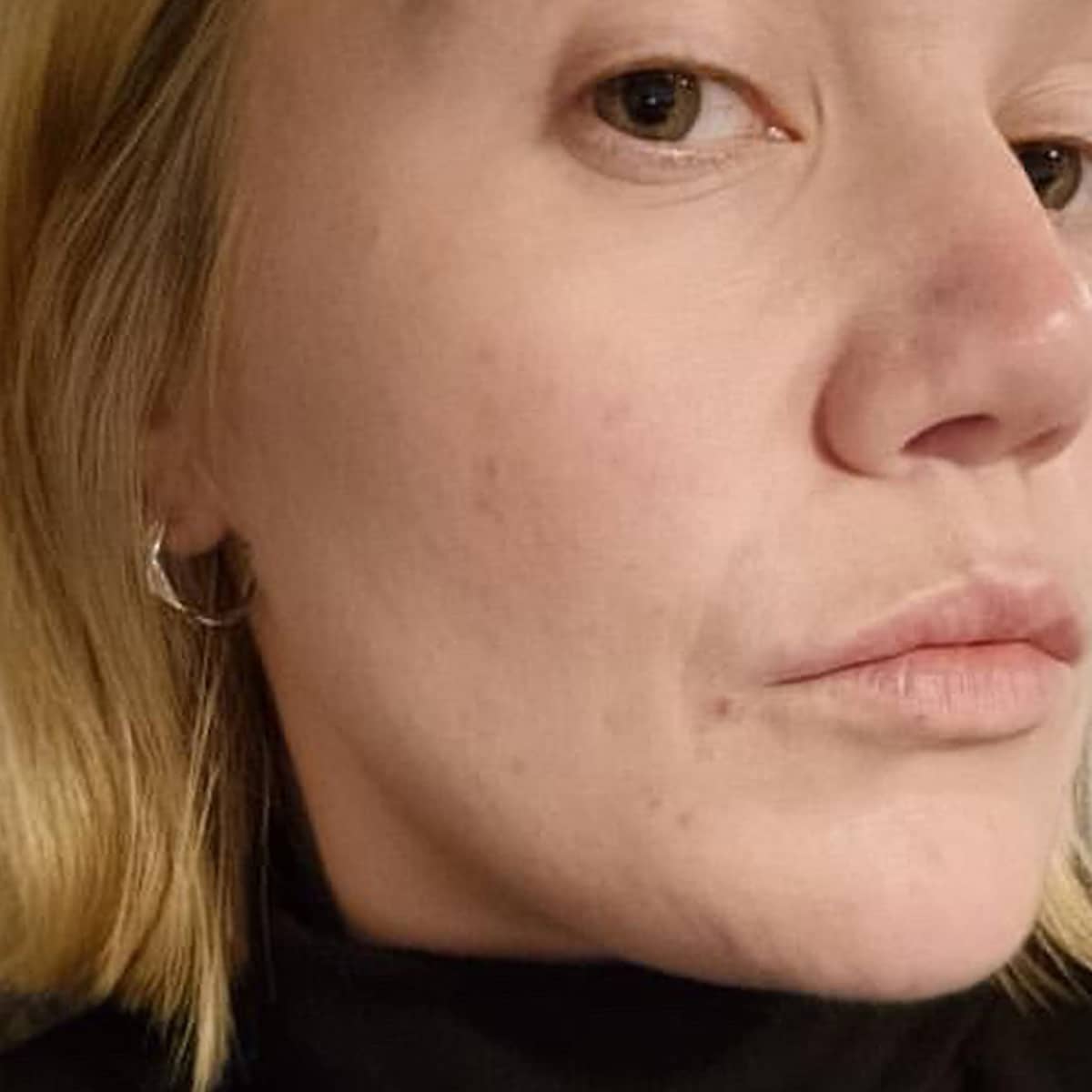 After image of Blemishes