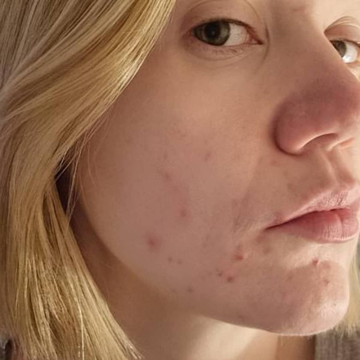 Before image of Blemishes