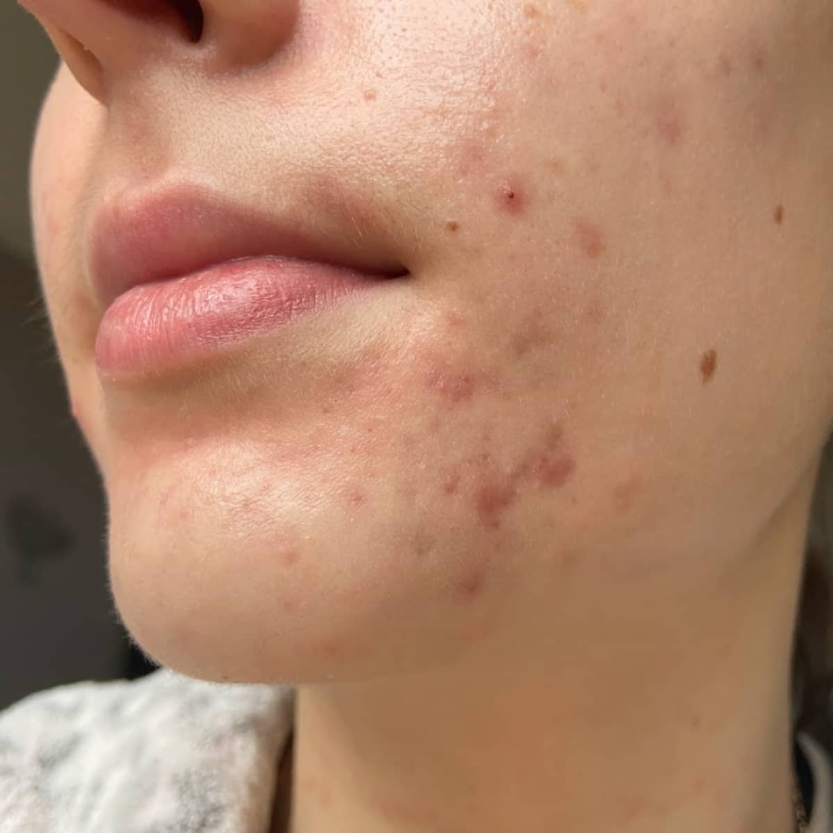 Before image of Blemishes & Pigmentation