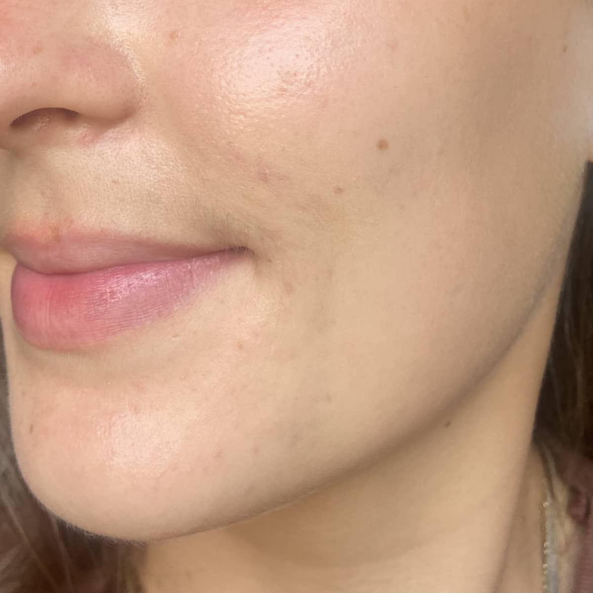 After image of Blemishes & Pigmentation