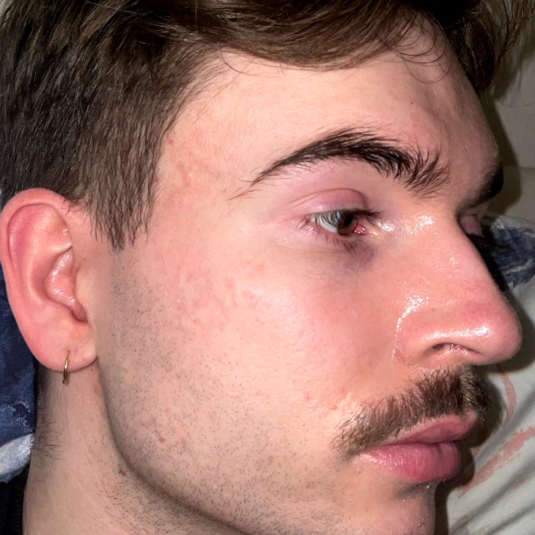 Before image of SAMUEL