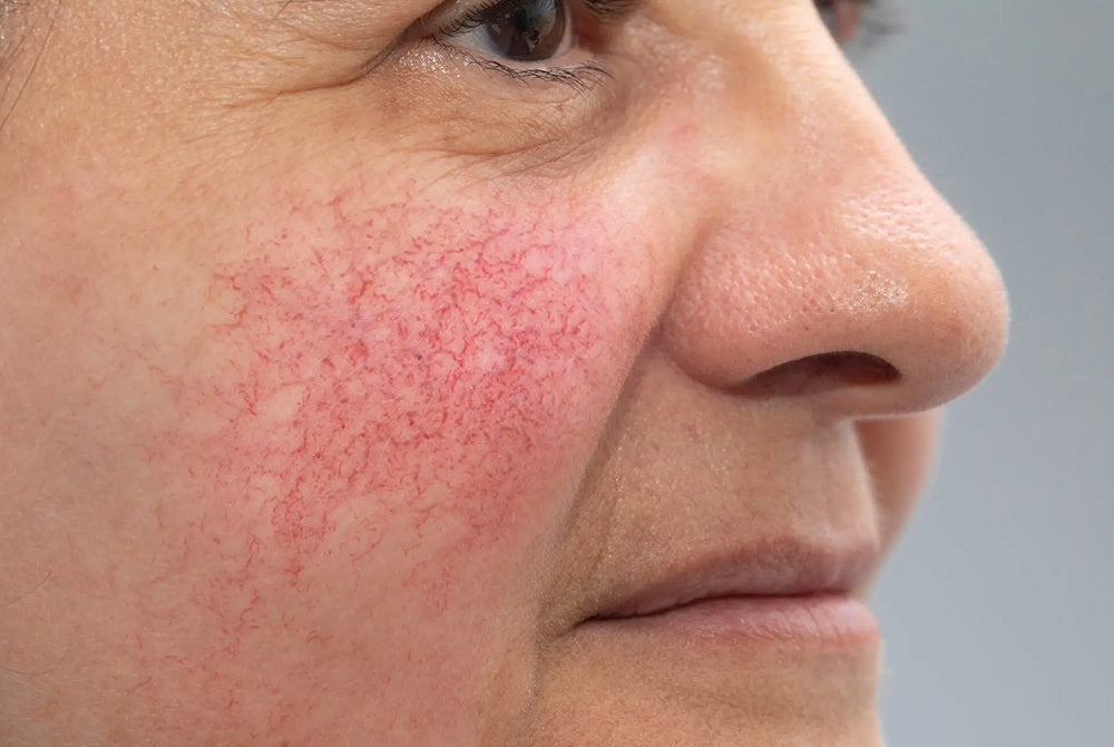 The pain points of Rosacea; what NOT to do from personal experience ...