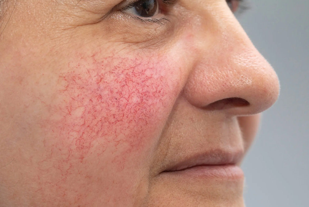 The pain points of Rosacea; what NOT to do from personal experience!