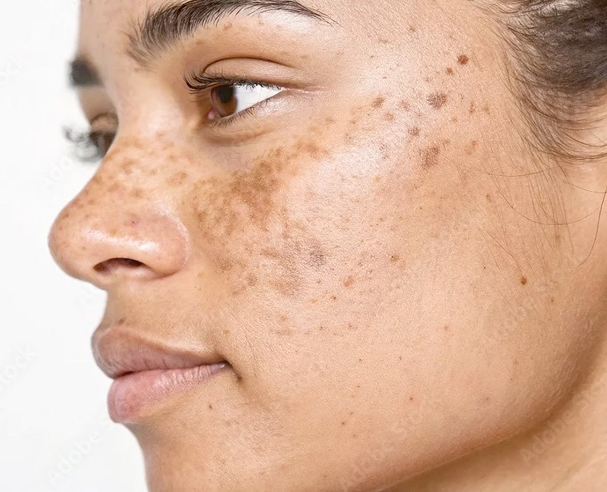 Hyperpigmentation: The Complete Guide to Understanding, Treating and Preventing Uneven Skin Tone