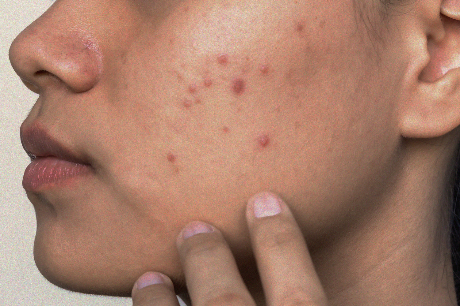 Acne: When Is The Right Time To Seek Expert Help?