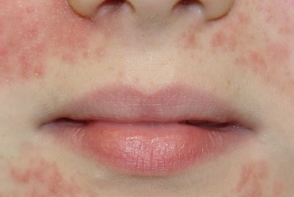 Perioral Rash In Children How To Treat Perioral Dermatitis Effectively – Dr Sam's