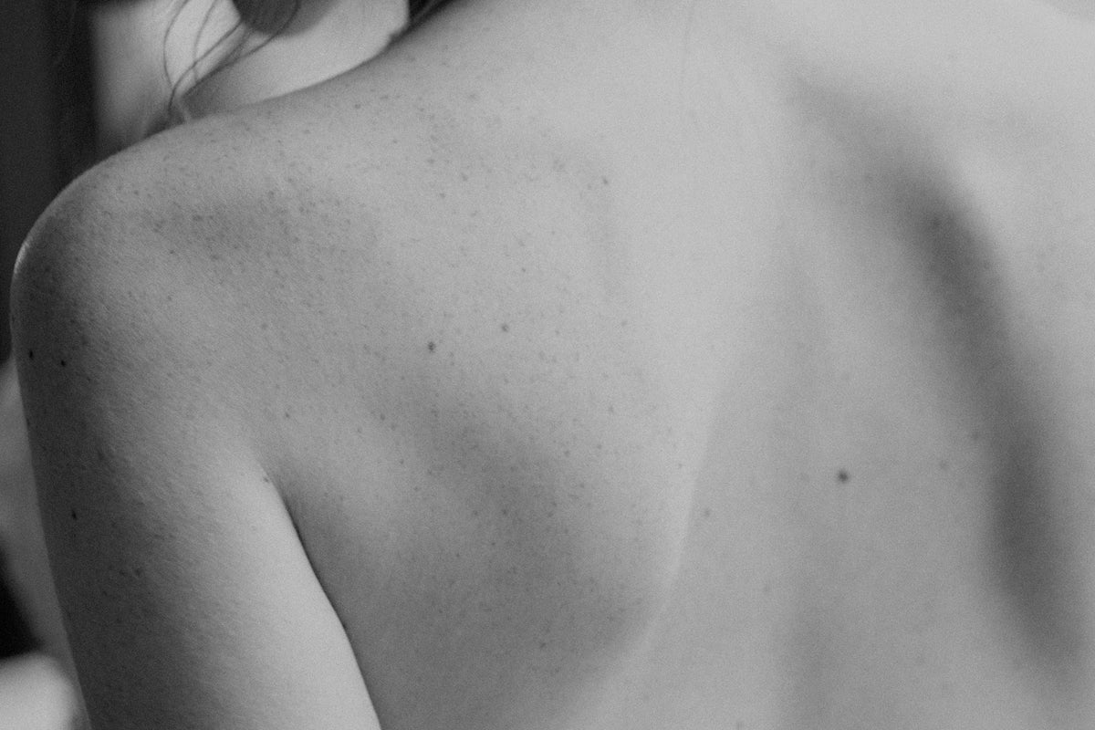 How To Get Rid of Bacne – Dr Sam's