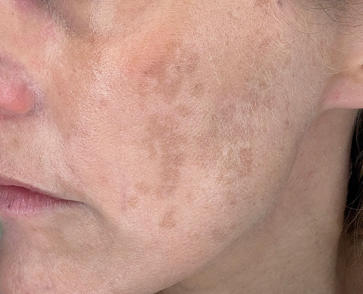 Hyperpigmentation example on cheek
