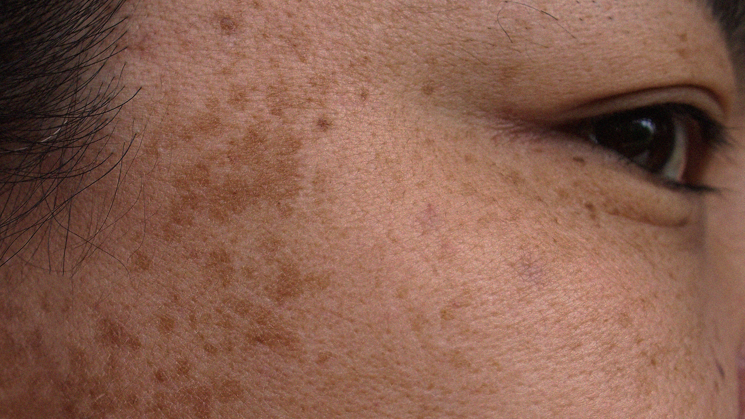 How To Treat Hyperpigmentation