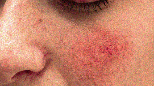 Rosacea - The 8 Things Everyone Needs To Know