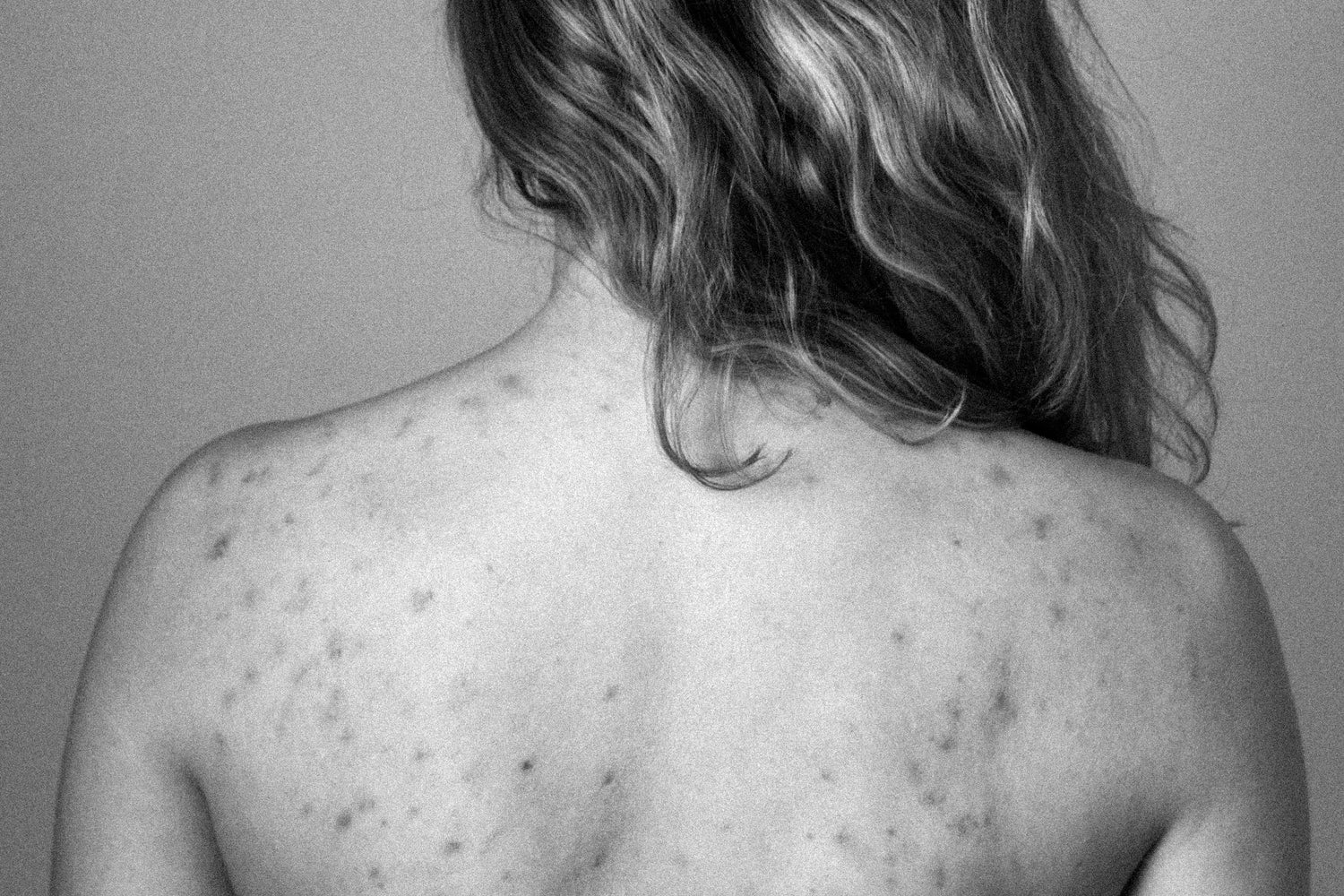 Why Keratosis Pilaris is HELL in winter - and how to fix it!