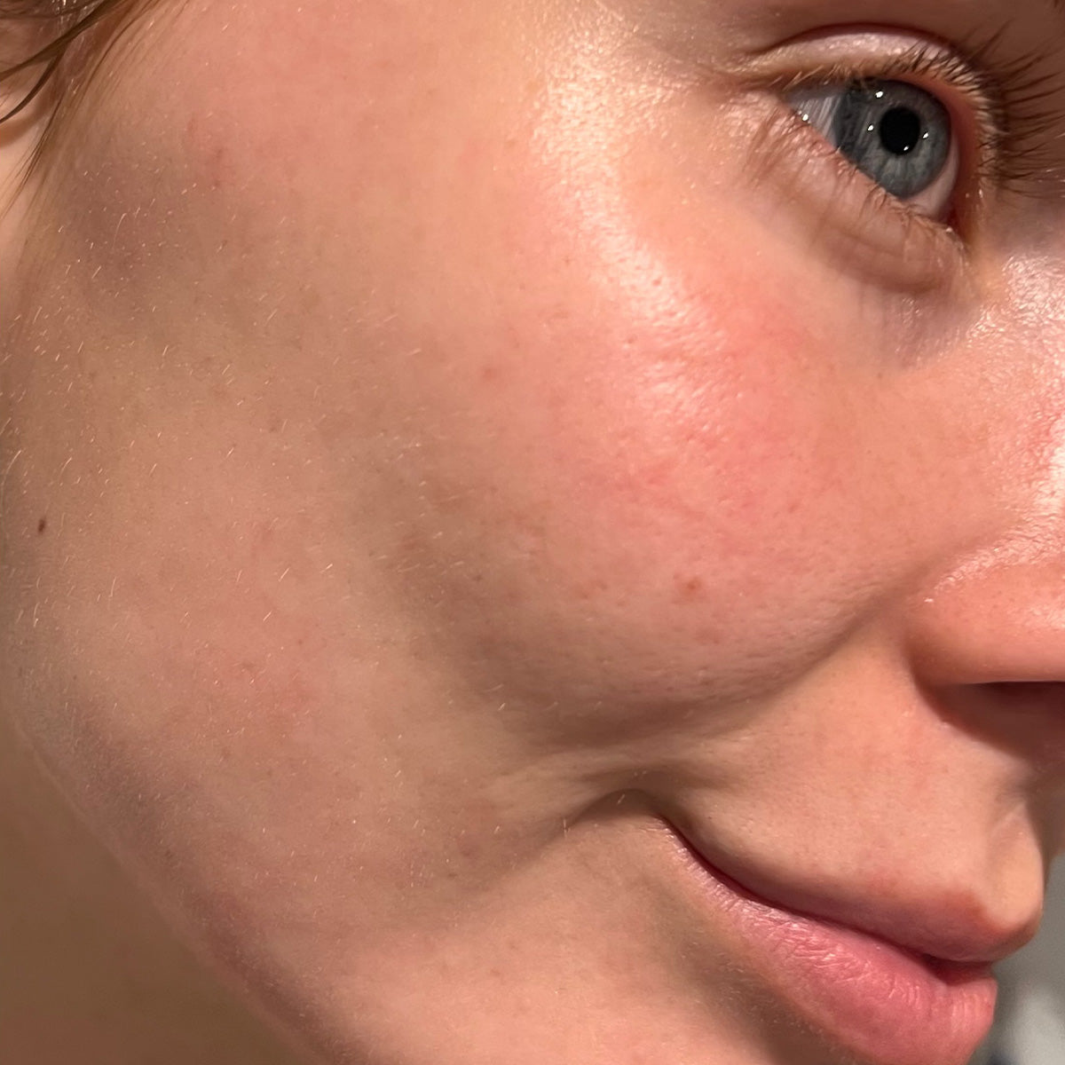 After image of CLOSED COMEDONES