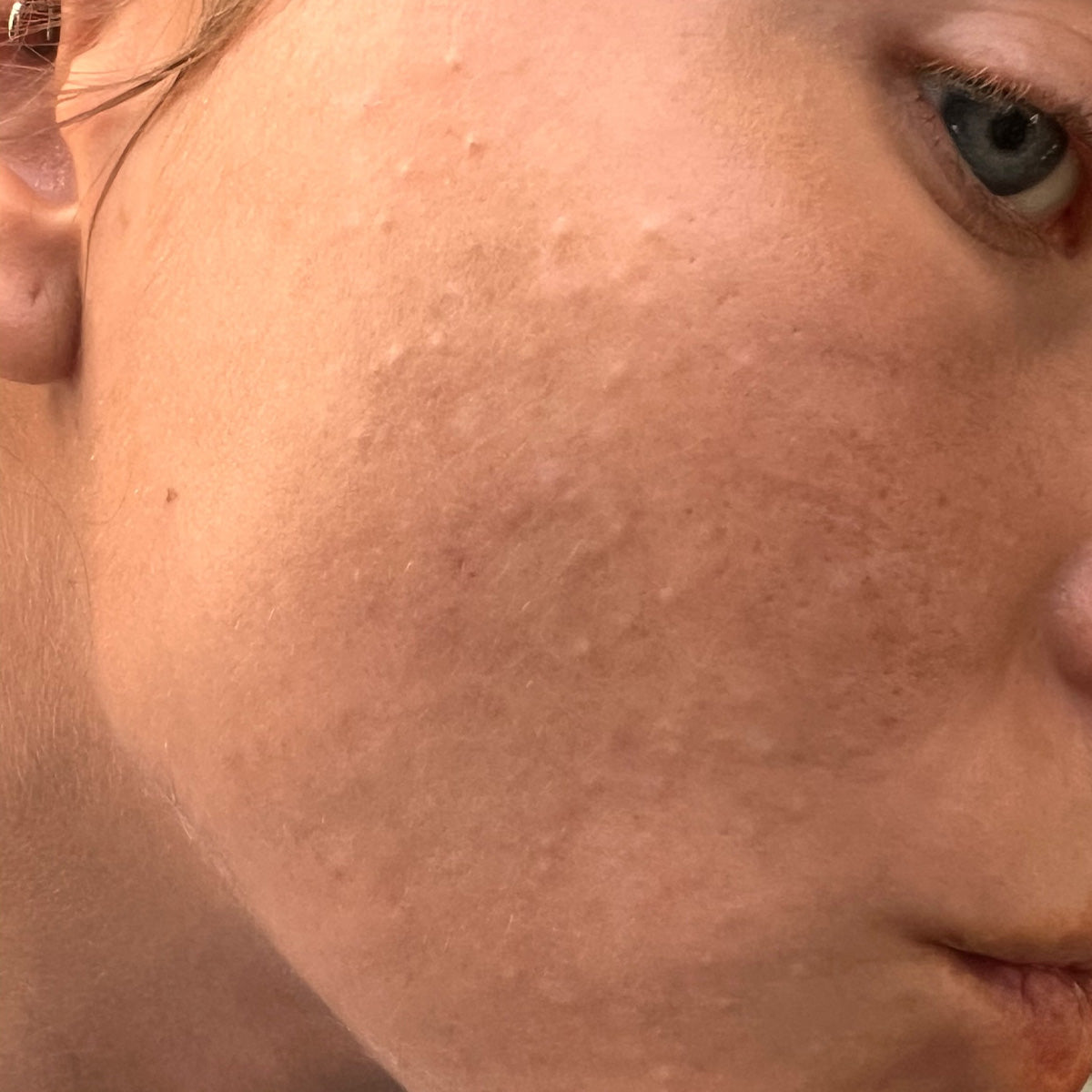 Before image of CLOSED COMEDONES