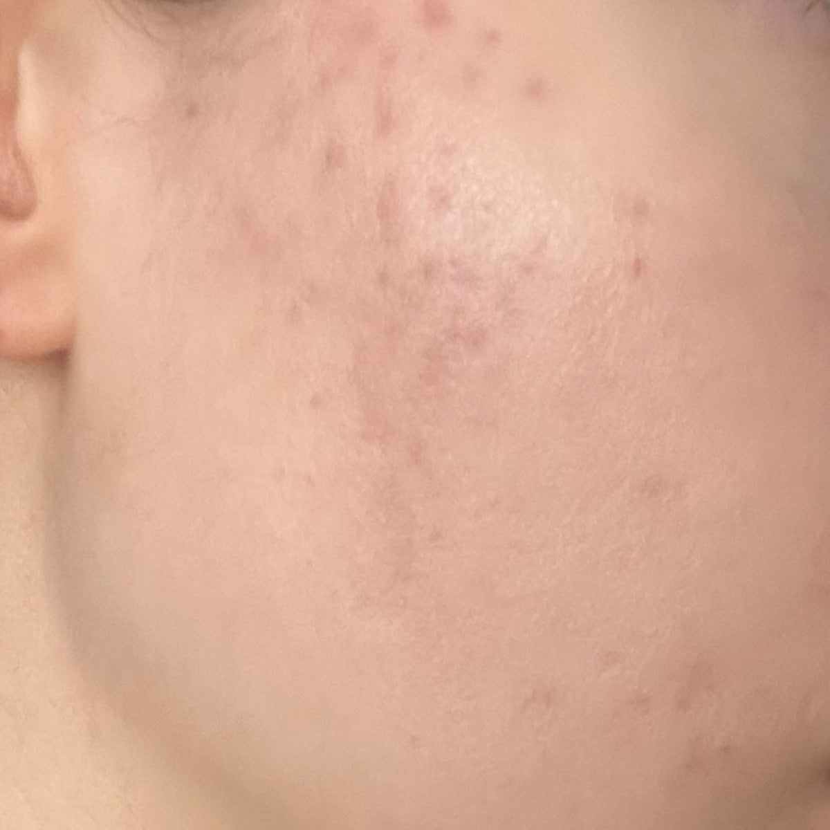 After image of Blemishes