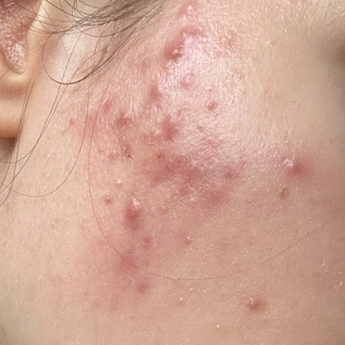 Before image of REDNESS