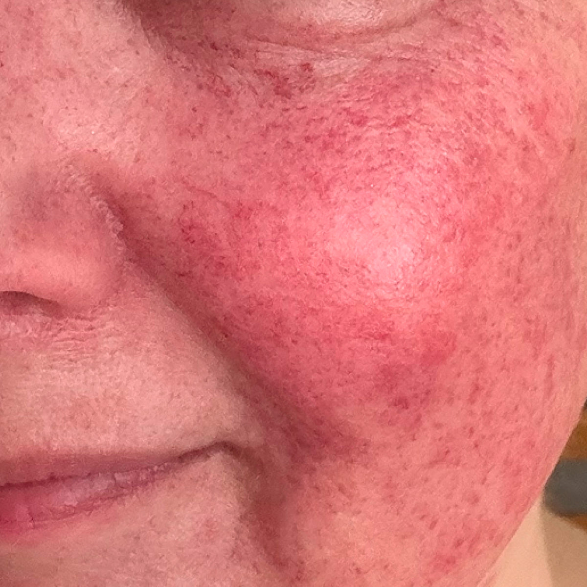 Before image of REDNESS