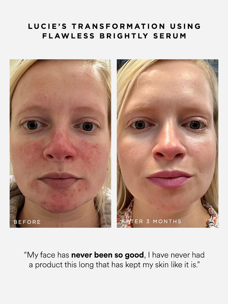 Flawless Brightly 10% Azelaic Acid Serum | Dr Sam's