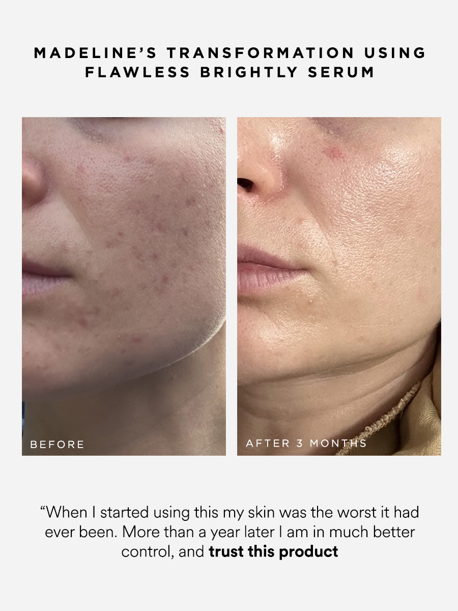 Flawless Brightly 10% Azelaic Acid Serum | Dr Sam's