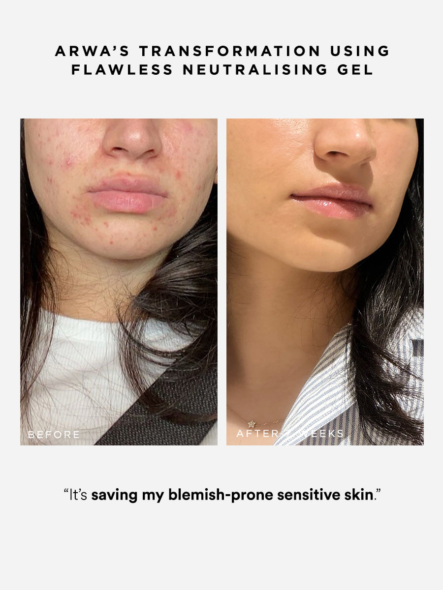 Flawless Neutralising Gel | Azelaic Acid, Salicylic Acid for Acne