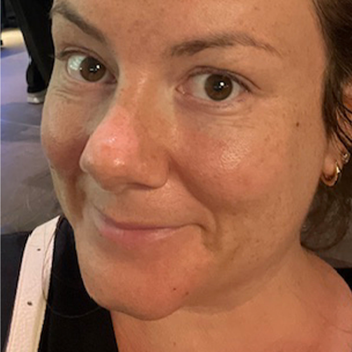 Before image of Pigmentation