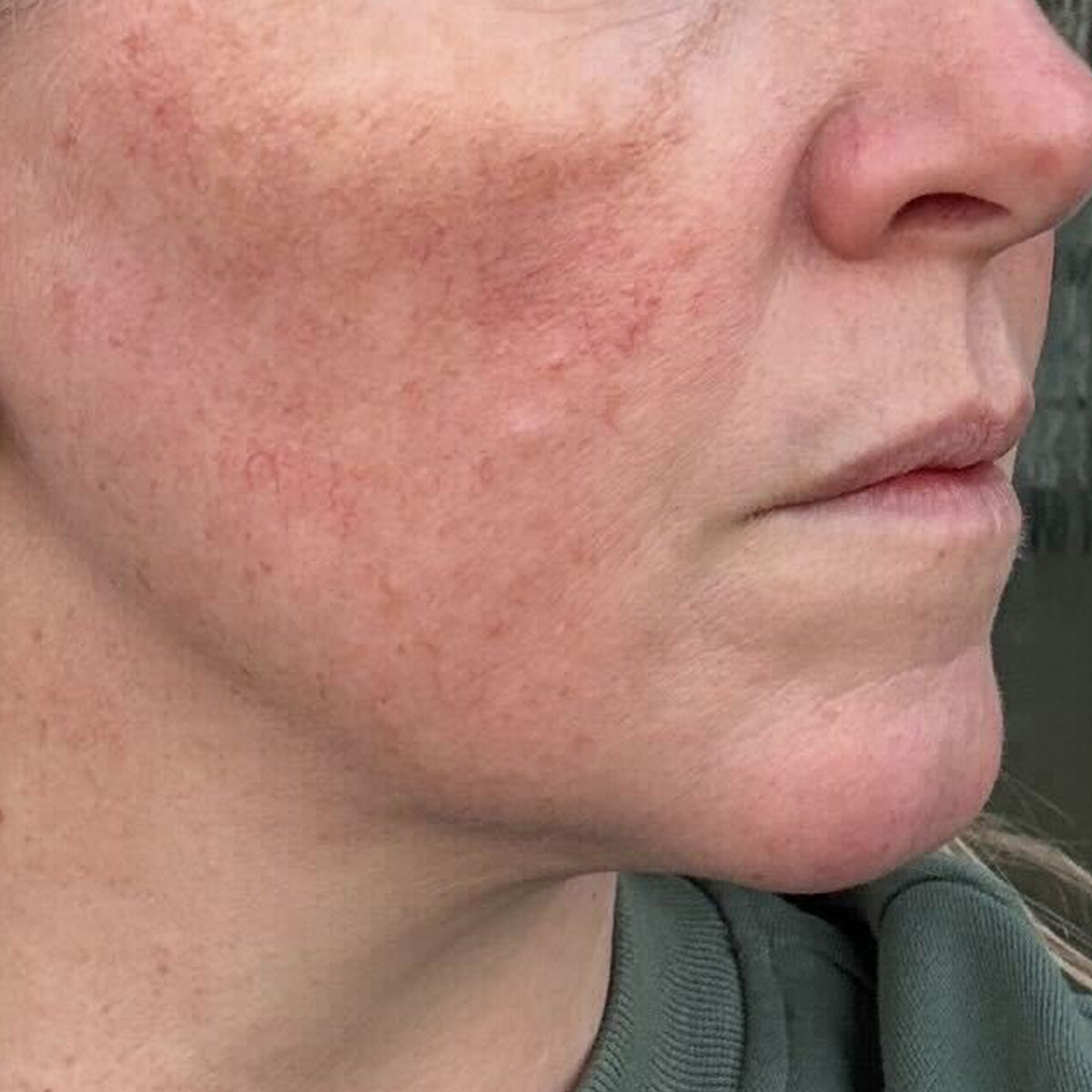 After image of Rosacea