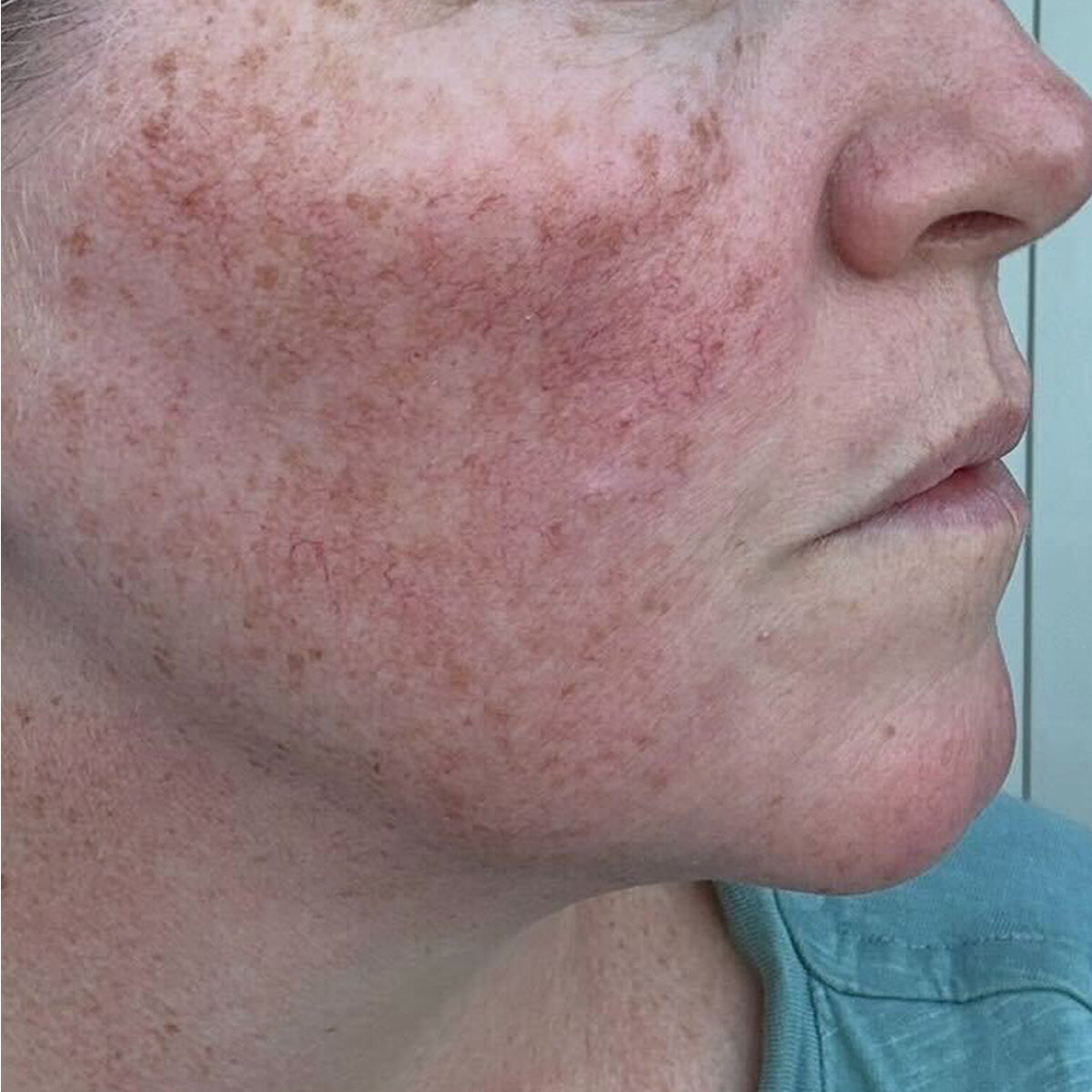 Before image of Rosacea