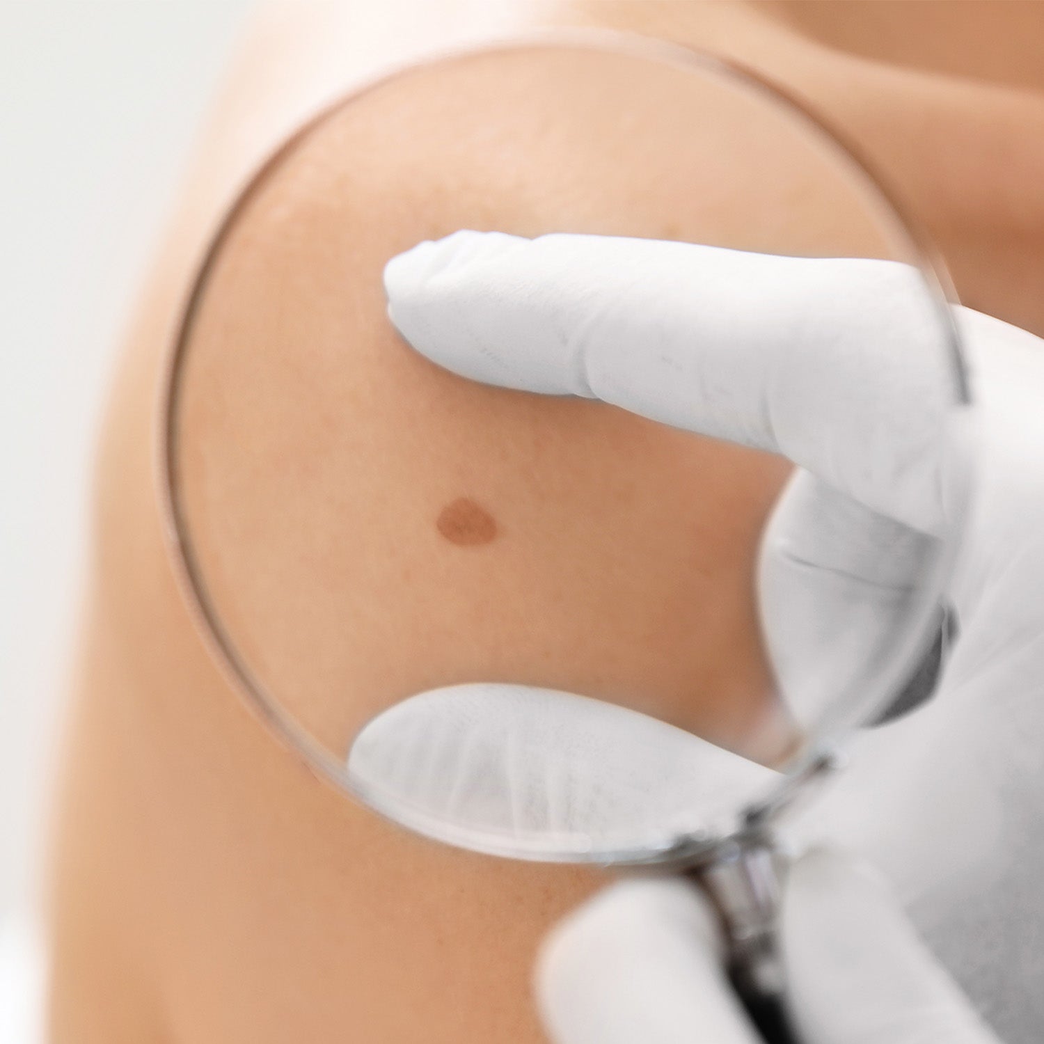 Image representing Mole Removal