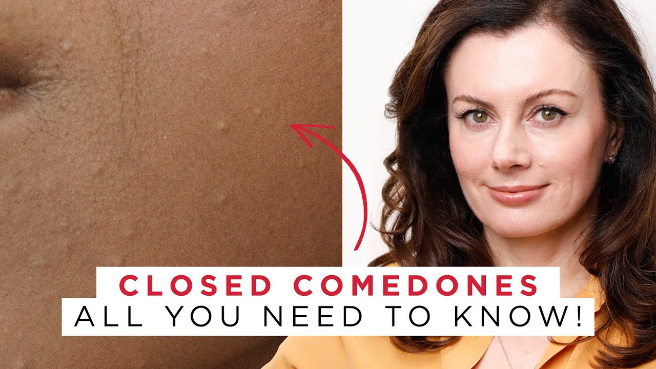 How to Tackle Closed Comedones + Texture - Avoid These Mistakes