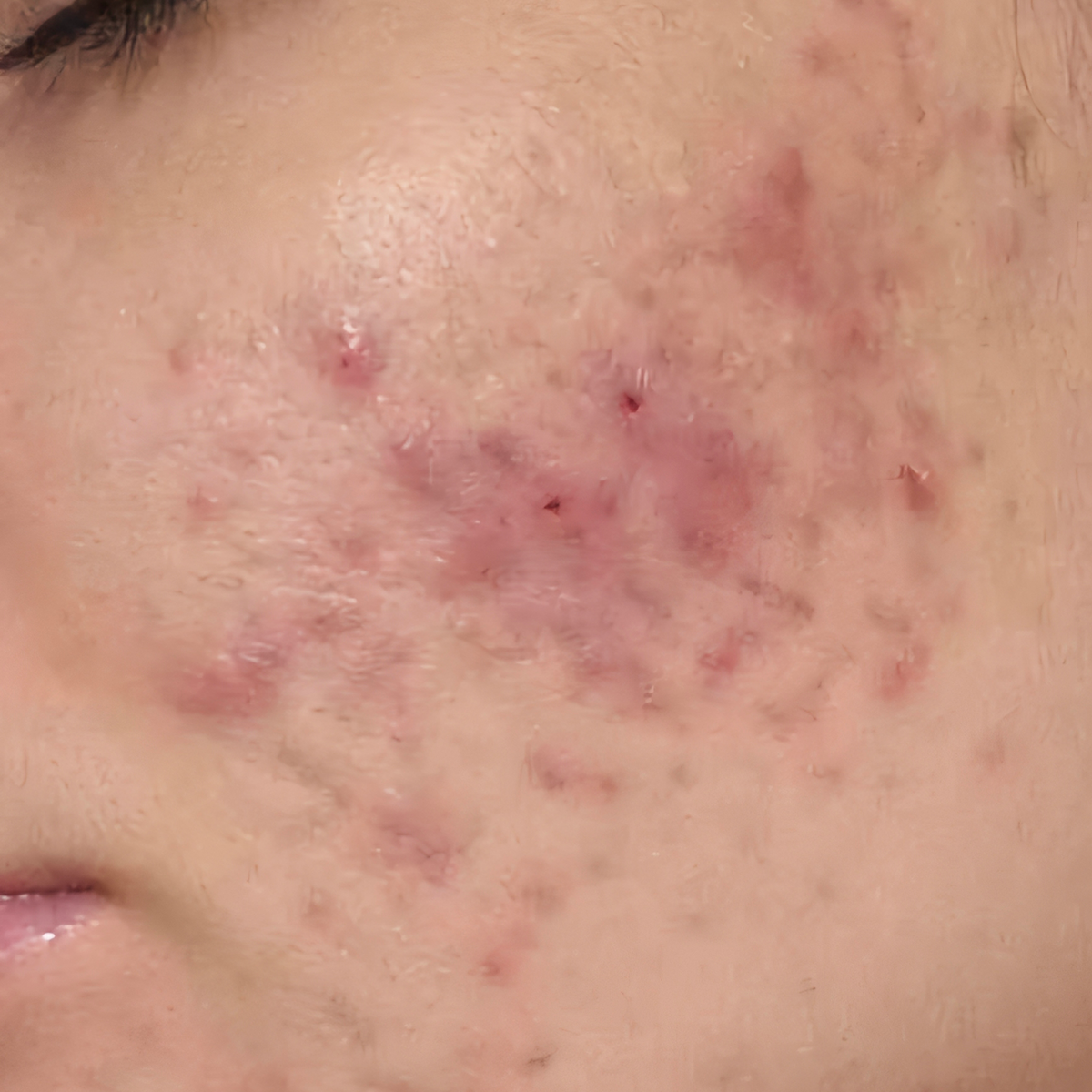 Before image of LORA