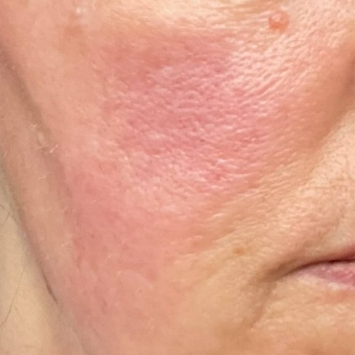Before image of Redness